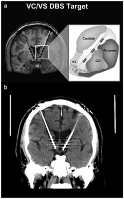 Case Report: Deep Brain Stimulation to the Ventral Internal Capsule/Ventral Striatum Induces Repeated Transient Episodes of Voltage-Dependent Tourette-Like Behaviors